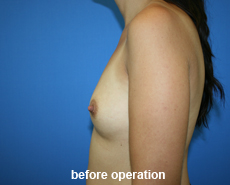 plastic-surgery-breast-augmentation